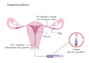 donor-insemination