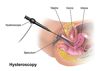 hysteroscopic