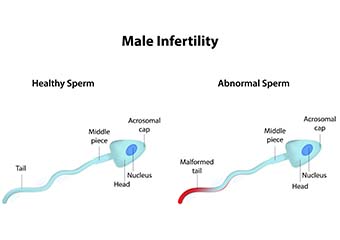 male-infertility